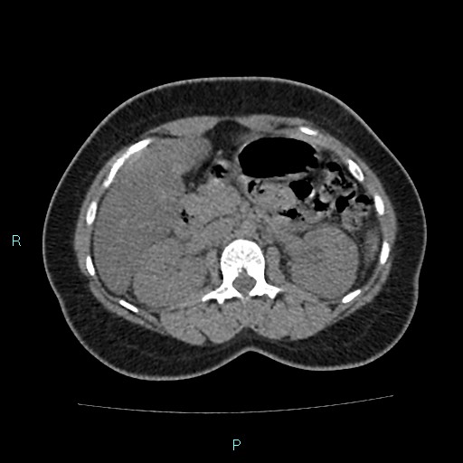 Acute bilateral pyelonephritis (Radiopaedia 37146-38881 Axial non-contrast 41).jpg
