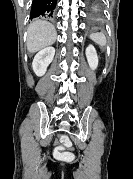 Acute bowel ischemia (Radiopaedia 87695-104114 Coronal C+ portal venous phase 299).jpg
