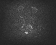 File:Acute cerebellar ataxia (Radiopaedia 61487-69446 Axial DWI 1).jpg