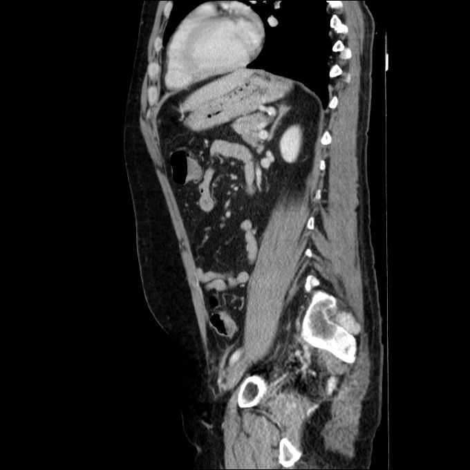 Acute cholecystitis and incidental left sided IVC (Radiopaedia 49352-54459 Sagittal C+ portal venous phase 36).jpg