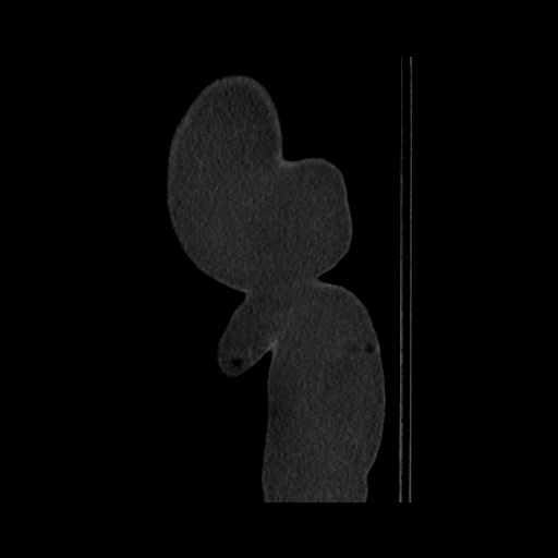 File:Acute cholecystitis with tensile fundus sign (Radiopaedia 71394-81723 Sagittal non-contrast 167).jpg