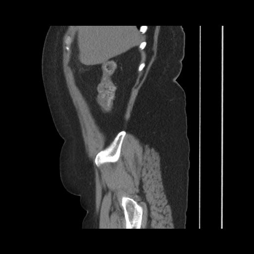 Acute cholecystitis with tensile fundus sign (Radiopaedia 71394-81723 Sagittal non-contrast 45).jpg