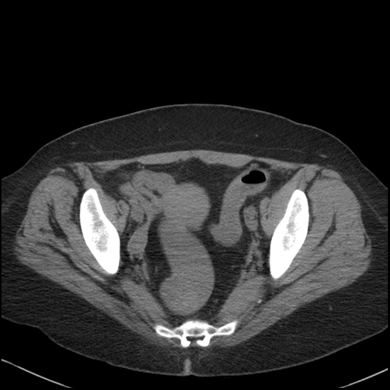 Acute colonic hemorrhage in ulcerative colitis (Radiopaedia 77415-89538 Axial non-contrast 115).jpg