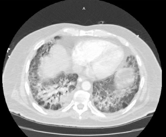 Acute cor pulmonale (ultrasound) (Radiopaedia 83508-98818 Axial lung window 63).jpg