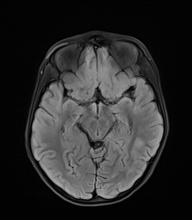 File:Acute disseminating encephalomyelitis with bilateral optic neuritis (Radiopaedia 79676-92886 Axial FLAIR 11).jpg