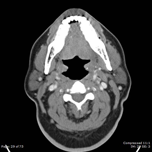 Acute epiglottitis (Radiopaedia 54375-60590 Axial C+ arterial phase 29).jpg