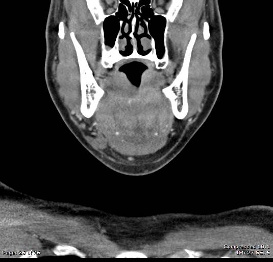 Acute epiglottitis (Radiopaedia 54375-60590 Coronal C+ arterial phase 26).jpg