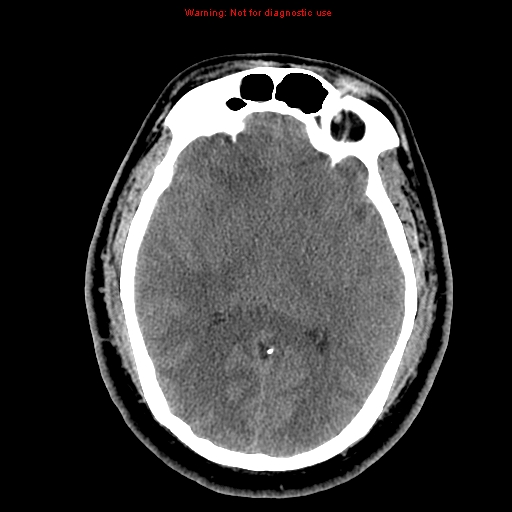 File:Acute hemorrhagic leukoencephalitis (Radiopaedia 14076-13920 Axial non-contrast 23).jpg