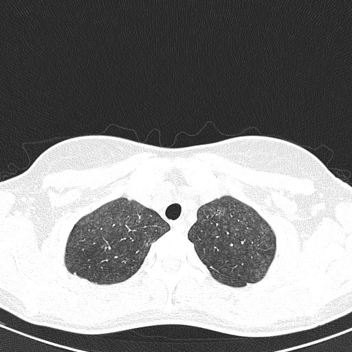 File:Acute hypersensitivity pneumonitis (Radiopaedia 85293-100870 Axial lung window 15).jpg