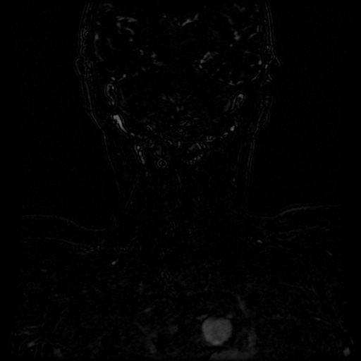Acute internal carotid artery dissection (Radiopaedia 53541-59632 Coronal MRA 5).jpg
