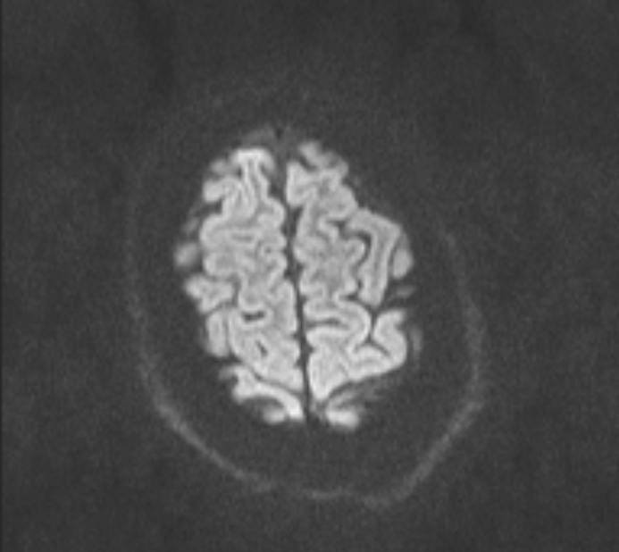 Acute ischemic stroke - posterior circulation territory (Radiopaedia 77670-89880 Axial DWI 67).jpg