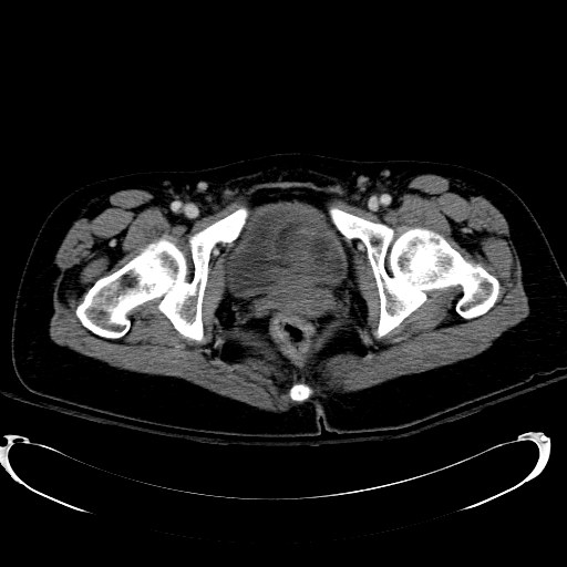 Acute myocardial infarction in CT (Radiopaedia 39947-42415 Axial C+ portal venous phase 132).jpg