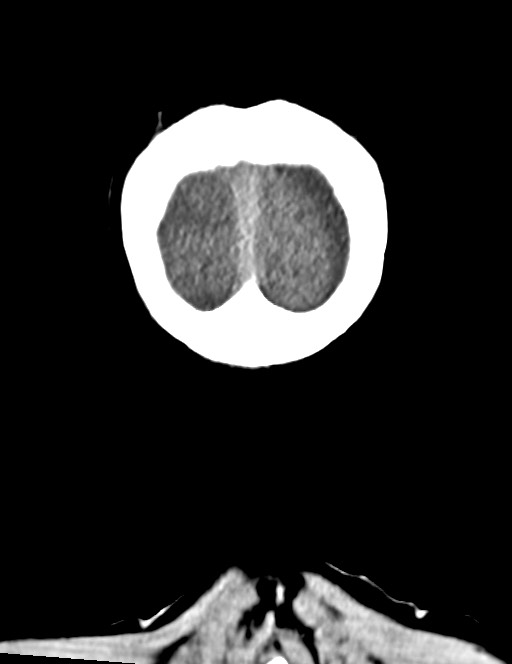 Acute on chronic subdural hematoma (Radiopaedia 74814-85823 Coronal non-contrast 61).jpg