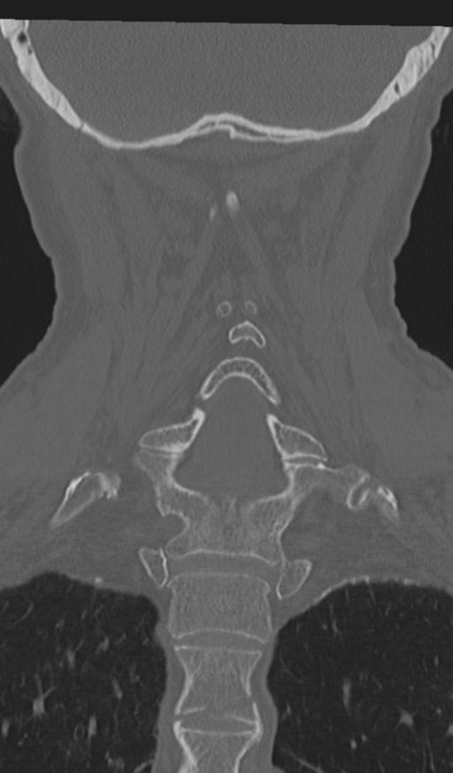 Acute on chronic subdural hematoma and thoracic vertebral injury in a multitrauma patient (Radiopaedia 31698-32619 Coronal bone window 43).jpg
