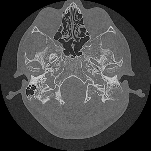 Acute otomastoiditis and Bezold abscess (Radiopaedia 88184-104786 Axial bone window 20).jpg