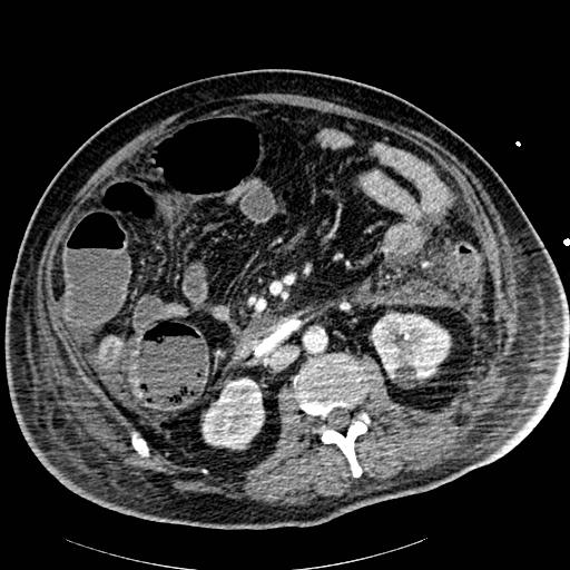 Acute pancreatic necrosis (Radiopaedia 13560-18502 Axial C+ portal venous phase 50).jpg