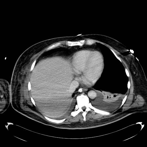 File:Acute pancreatic necrosis (Radiopaedia 13560-18503 Axial C+ portal venous phase 3).jpg