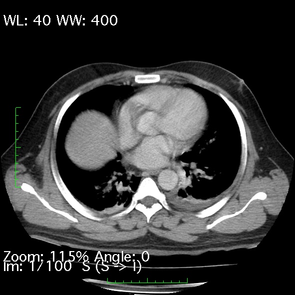 Acute pancreatitis (Radiopaedia 34043-35276 Axial C+ portal venous phase 1).jpg