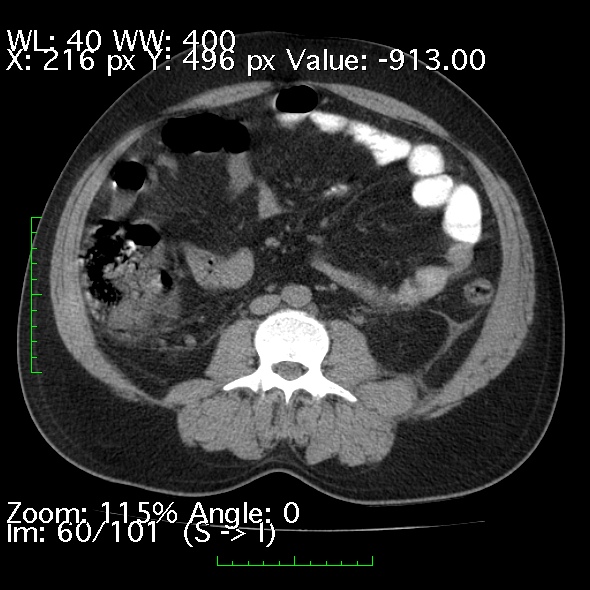 Acute pancreatitis (Radiopaedia 34043-35276 Axial non-contrast 60).jpg