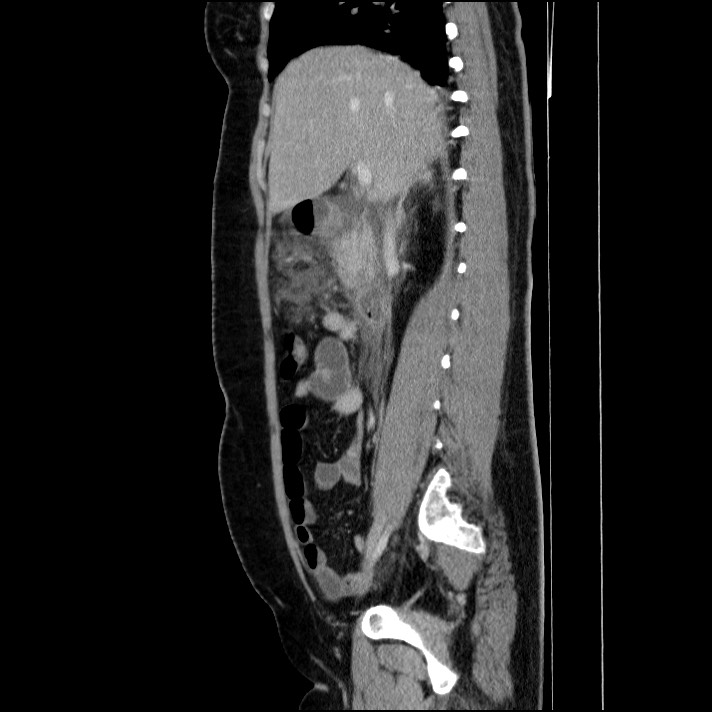 Acute pancreatitis (Radiopaedia 69236-79012 Sagittal C+ portal venous phase 63).jpg