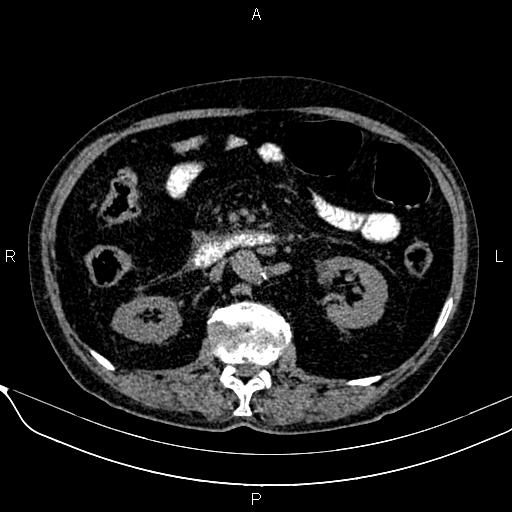 Acute pancreatitis (Radiopaedia 85146-100701 Axial non-contrast 57).jpg