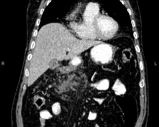 Acute pancreatitis (Radiopaedia 85146-100701 Coronal C+ portal venous phase 21).jpg