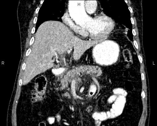 Acute pancreatitis (Radiopaedia 85146-100701 Coronal C+ portal venous phase 30).jpg