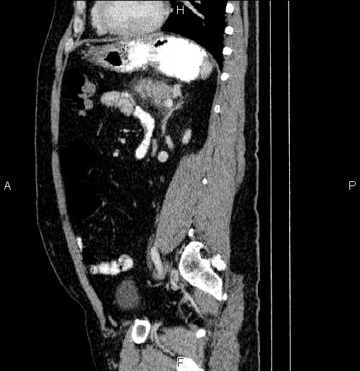 Acute pancreatitis (Radiopaedia 85390-101010 Sagittal C+ portal venous phase 67).jpg