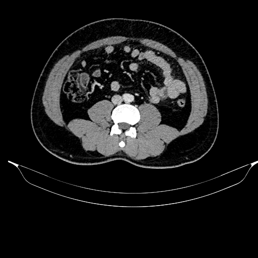 File:Acute pancreatitis (Radiopaedia 87428-103757 Axial C+ portal venous phase 60).jpg