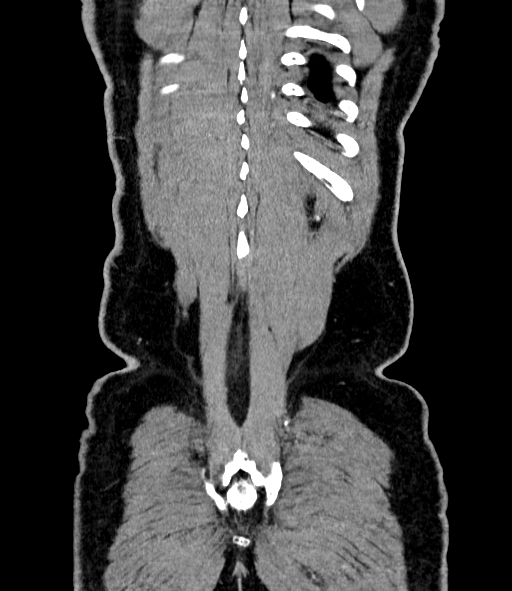 Acute pancreatitis (Radiopaedia 87428-103757 Coronal C+ portal venous phase 85).jpg