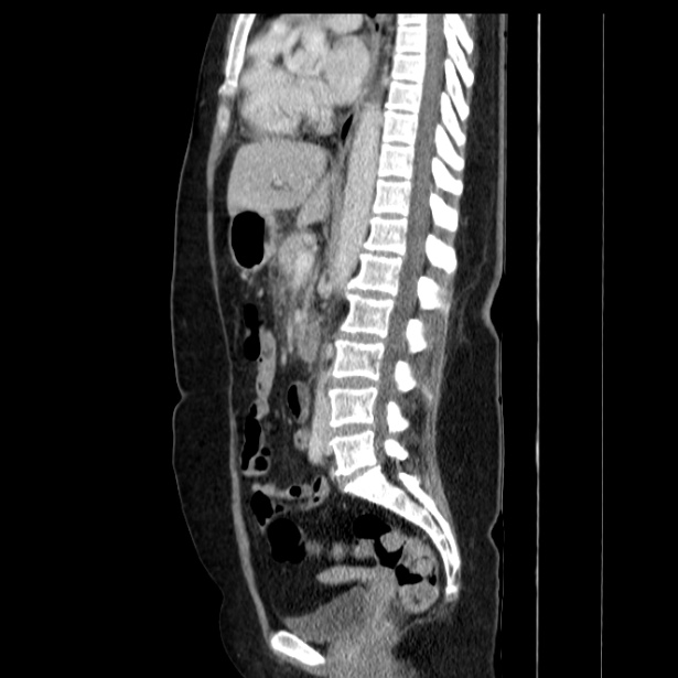 Acute pancreatitis - Balthazar C (Radiopaedia 26569-26714 Sagittal C+ portal venous phase 35).jpg