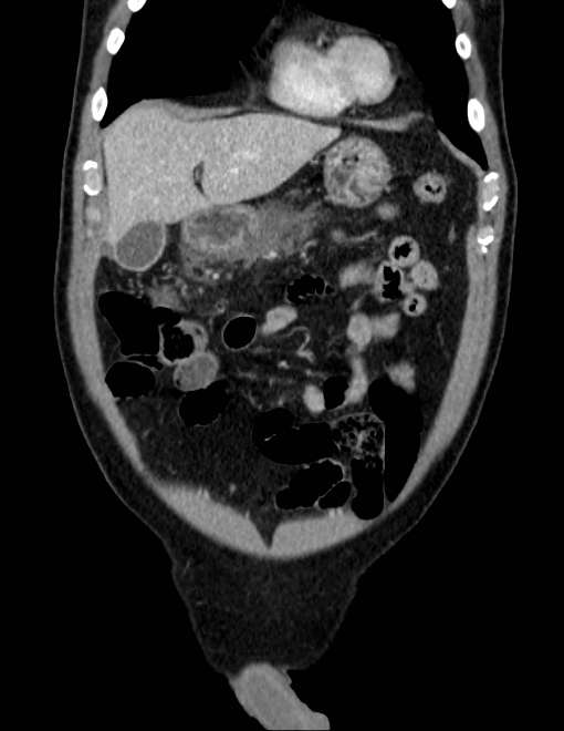 Acute pancreatitis - Balthazar E (Radiopaedia 23080-23110 Coronal C+ portal venous phase 15).jpg