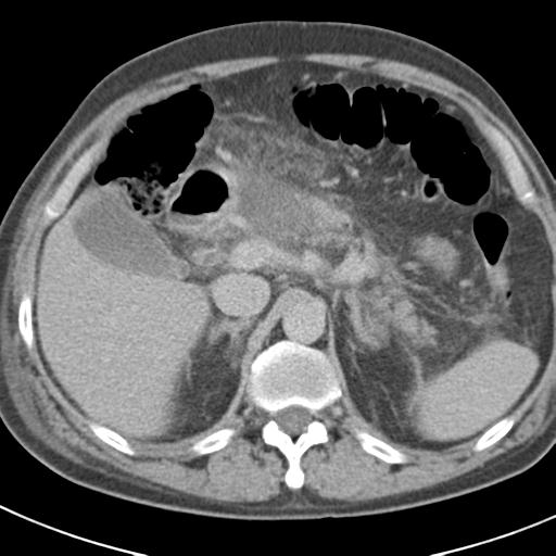 Acute pancreatitis and walled-off necrosis (Radiopaedia 29888-30403 Axial C+ delayed 27).jpg