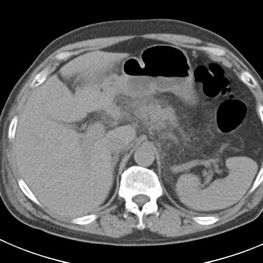 File:Acute pancreatitis and walled-off necrosis (Radiopaedia 29888-30403 Axial non-contrast 15).jpg