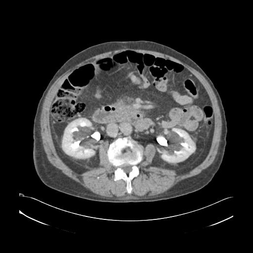 Acute pancreatitis and walled-off necrosis (Radiopaedia 29888-30403 E 1).jpg