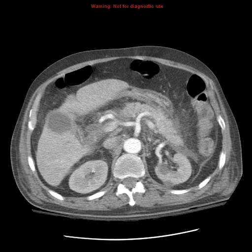 Acute pancreatitis with incidental pancreatic lipoma (Radiopaedia 10190-10730 Axial C+ arterial phase 35).jpg