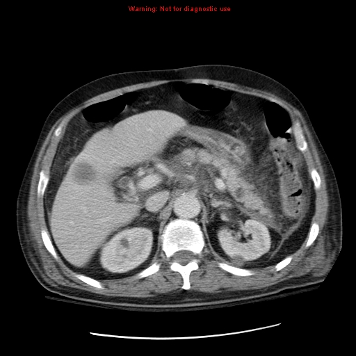 File:Acute pancreatitis with incidental pancreatic lipoma (Radiopaedia 10190-10730 Axial C+ portal venous phase 21).jpg