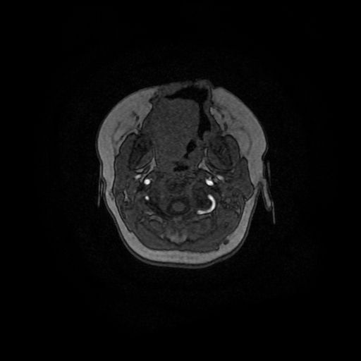 Acute phase of hemiconvulsion-hemiplegia epilepsy syndrome (Radiopaedia 29309-29745 Axial TOF angiography 166).jpg