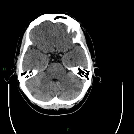 Acute posterior cerebral artery territory infarct (Radiopaedia 79329-92393 Axial non-contrast 31).jpg