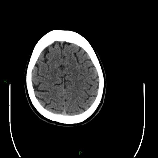 Acute posterior cerebral artery territory infarct (Radiopaedia 79329-92393 Axial non-contrast 89).jpg