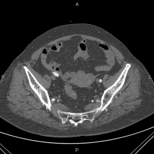 Acute renal artery occlusion (Radiopaedia 86586-102682 Axial C+ arterial phase 80).jpg