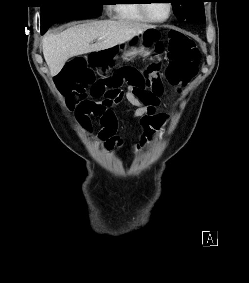 Acute renal infarction (Radiopaedia 59375-66736 Coronal C+ portal venous phase 16).jpg