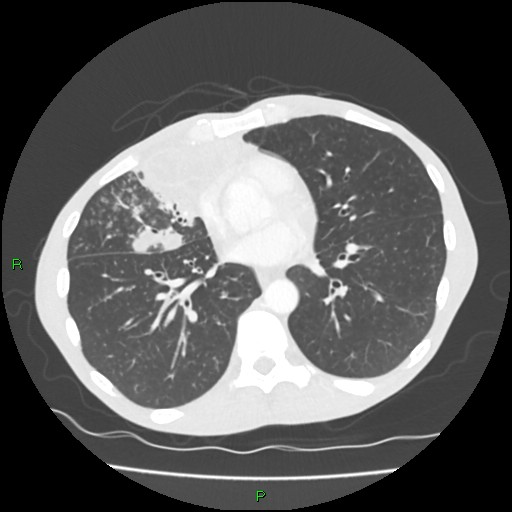 File:Acute right lung abscess (Radiopaedia 34806-36258 Axial lung window 115).jpg
