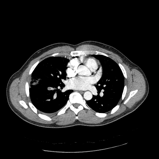 Acute segmental pulmonary emboli and pulmonary infarction (Radiopaedia 62264-70444 Axial C+ CTPA 63).jpg