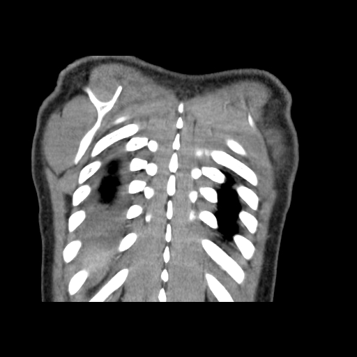 Acute segmental pulmonary emboli and pulmonary infarction (Radiopaedia 62264-70444 Coronal C+ CTPA 54).jpg