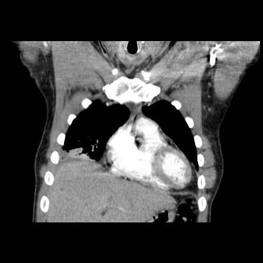 Acute segmental pulmonary emboli and pulmonary infarction (Radiopaedia 62264-70444 Coronal C+ CTPA 8).jpg