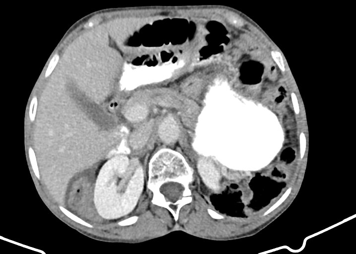 Acute small bowel (ileal) volvulus (Radiopaedia 71740-82139 Axial C+ portal venous phase 67).jpg