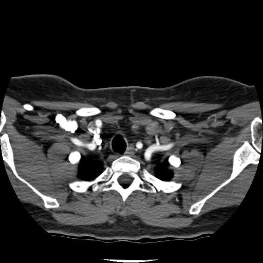 File:Acute subarachnoid hemorrhage and accessory anterior cerebral artery (Radiopaedia 69231-79009 Axial C+ arterial phase 26).jpg