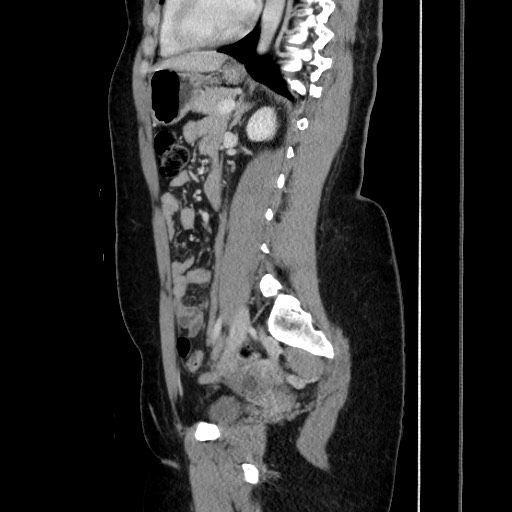 File:Acute uncomplicated appendicitis (Radiopaedia 73704-84499 Sagittal C+ portal venous phase 129).jpg