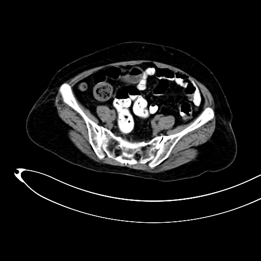 Adenocarcinoma colon with intussusception (Radiopaedia 86006-101922 Axial non-contrast 44).jpg